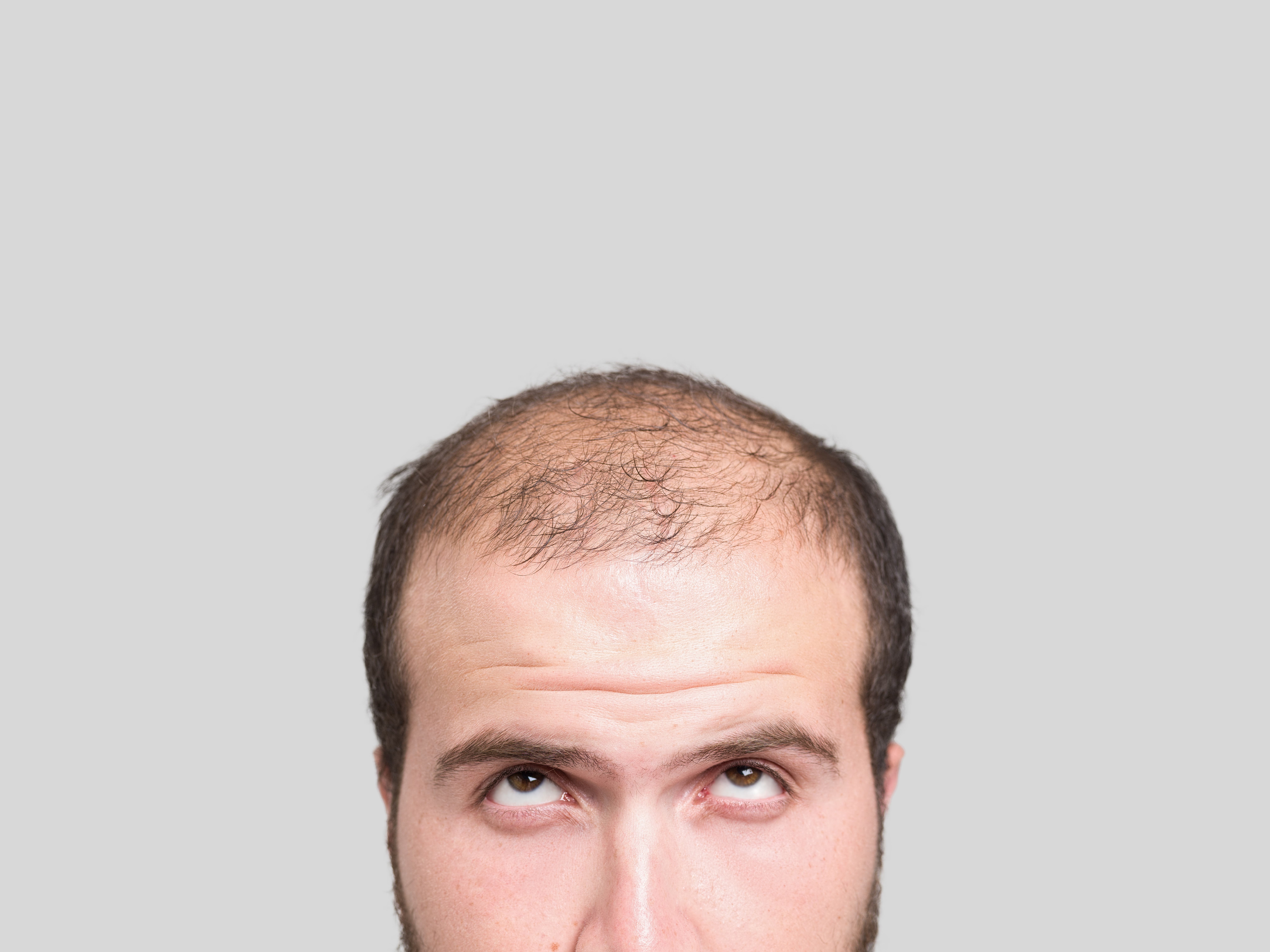 2 ключевые проблемы, из-за которых лысеют мужчины в возрасте 25+