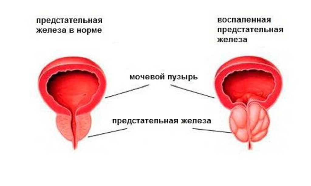 Топ-3 мужских болезней